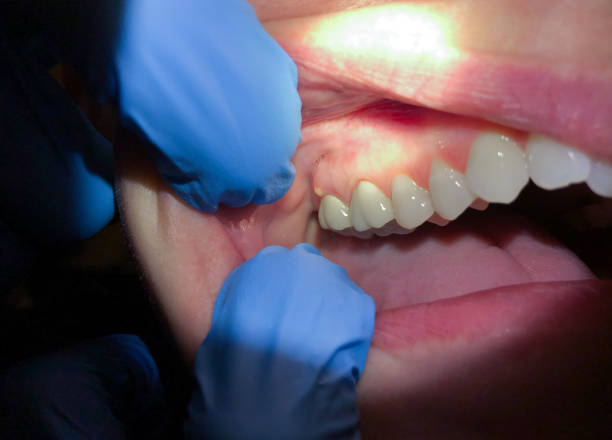 Best Emergency Treatment for Oral Infections in Grinnell, IA